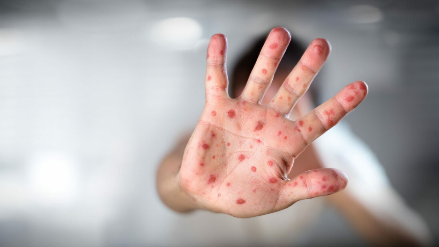 Alerta por nuevos casos de sarampión en CABA y AMBA